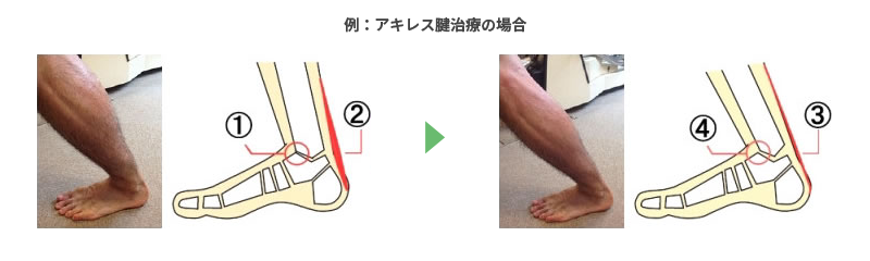 グラストンテクニックの施術例