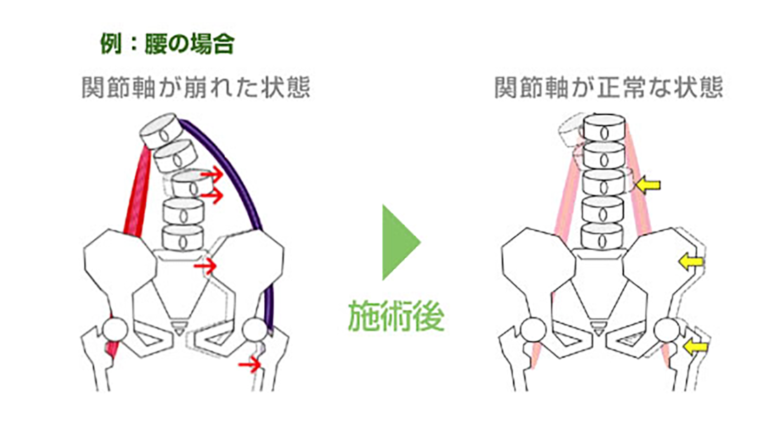 関節軸調整法施術例