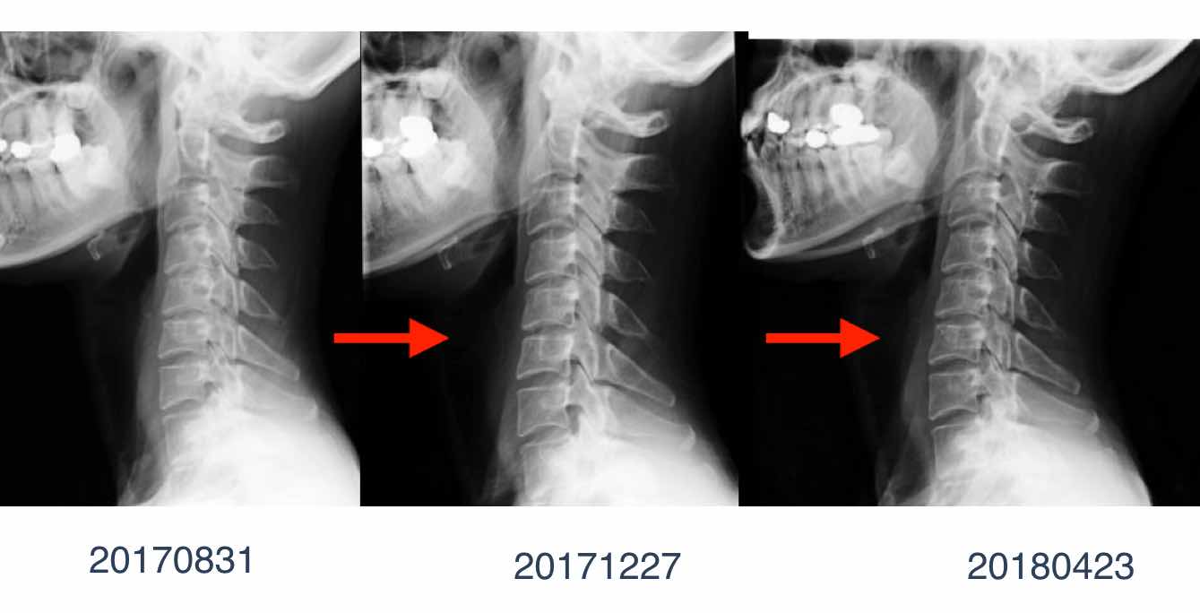 ストレートネック臨床研究 Kizuカイロプラクティック整体本院