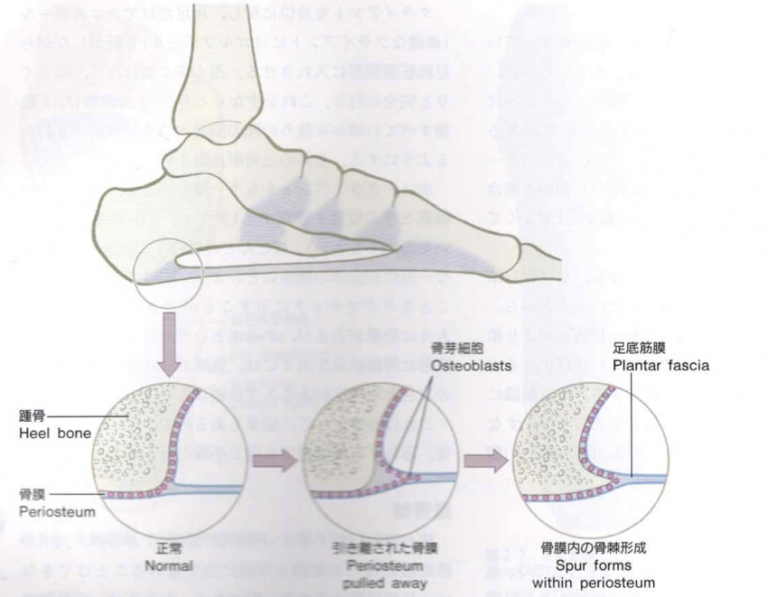 アスリートに多い踵部脂肪体炎（Heel Fat Pad Syndrome）の施術について ｜ KIZUカイロプラクティック整体本院